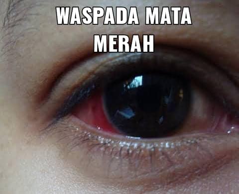 Ilustrasi berita Mimika: Kasus Mata Merah "Mewabah" di Timika, Penderita Ngaku 5 Hari Tersiksa, Dir RSUD : Jangan Sering Menyentuh