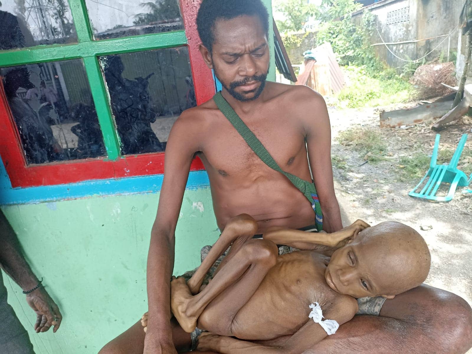 Ilustrasi berita Mimika: Ditemukan Kasus Gizi Buruk di Tengah Kota Timika, Bermula dari Cacingan, Anak Usia 5 Tahun Hanya Miliki Berat 6 Kilogram