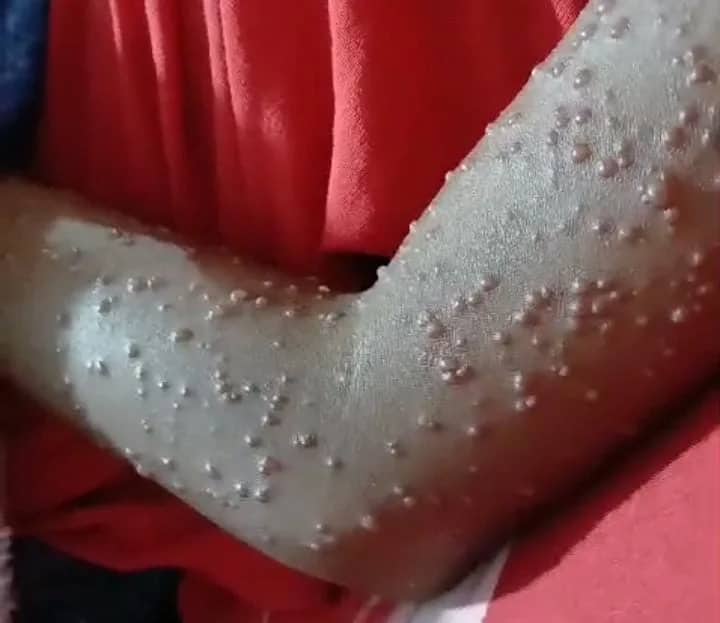 Ilustrasi berita Mimika: Virus Misterius Mirip Penyakit Cacar Monyet Menyerang Sejumlah Warga Kota Jayapura